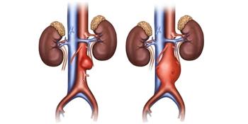 انتبه أعراض تمزق الشريان الأورطي