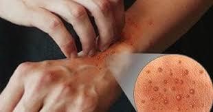 11 سبب لحساسية البرد في الشتاء