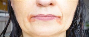 طرق للوقاية من الاسمرار حول الفم