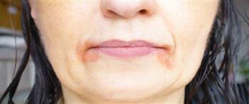 طرق للوقاية من الاسمرار حول الفم