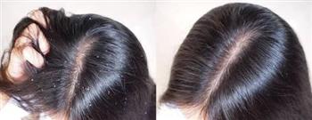 هذه هي أسباب قشرة الشعر في الشتاء