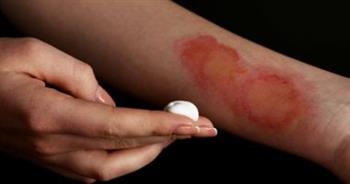 4 خطوات فورية يجب فعلها لإسعاف الحروق