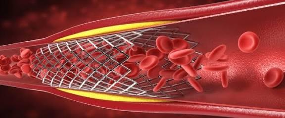 انتبه...علامات قد تشير إلى ضيق الشرايين!