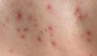 في الشتاء.. علامات وأسباب متلازمة الجلد المحمص