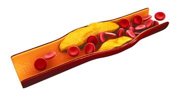 3 طرق للسيطرة على الكوليسترول