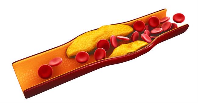 3 طرق للسيطرة على الكوليسترول