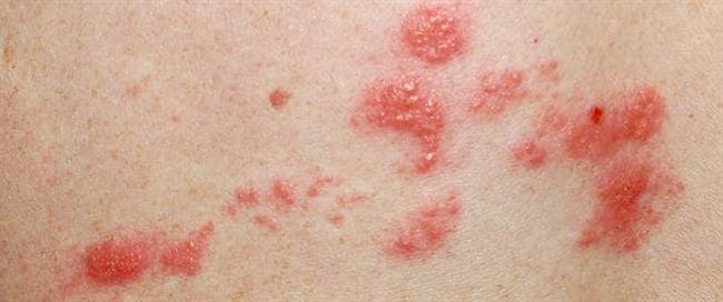 مضاعفات الإصابة بالحزام الناري