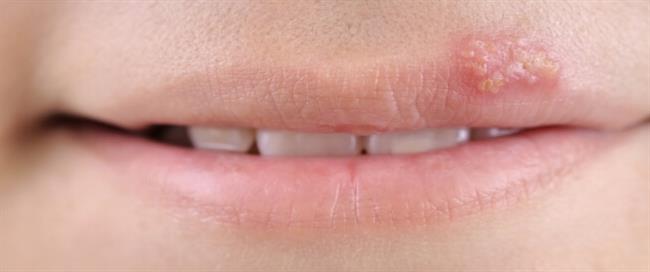 مع انخفاض درجة الحرارة .. احذر الهربس