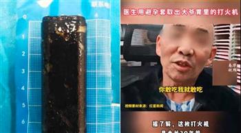 بداخلها الغاز.. صيني يعيش بولاعة سجائر في معدته لمدة 35 عامًا