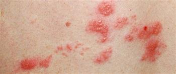 مضاعفات الإصابة بالحزام الناري