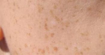 نصائح للوقاية من بقع الشمس " بقع العمر" 