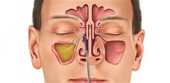 هل الجيوب الأنفية تؤثر على المعدة ؟