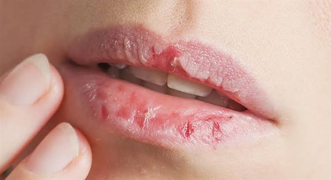 وصفة طبيعية لحماية شفتيك من التشقق في الشتاء