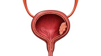 التهاب المثانة يصيب النسا أكتر من الرجال ..فما هي أسبابه؟