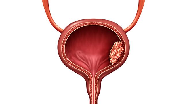 التهاب المثانة يصيب النسا أكتر من الرجال ..فما هي أسبابه؟