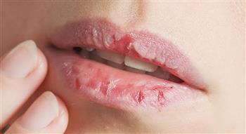 وصفة طبيعية لحماية شفتيك من التشقق في الشتاء