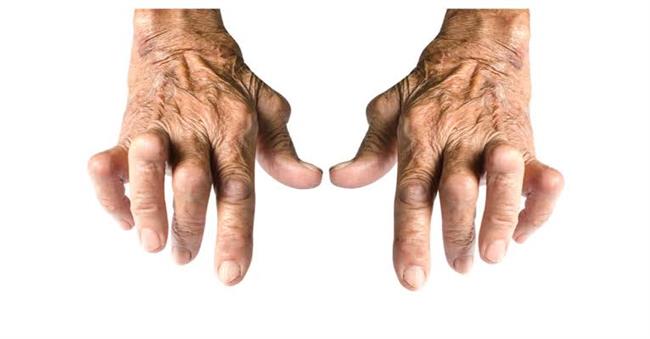 الدكتور‭ ‬أشرف‭ ‬عقبة‭ :‬أقصر‭ ‬طريق‭ ‬إلى‭ ‬شتاء‭ ‬بدون‭ ‬آلام‭ ‬الروماتيزم