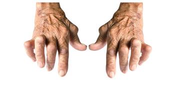 الدكتور‭ ‬أشرف‭ ‬عقبة‭ :‬أقصر‭ ‬طريق‭ ‬إلى‭ ‬شتاء‭ ‬بدون‭ ‬آلام‭ ‬الروماتيزم