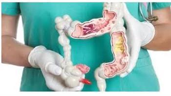 أعراض مبكرة لسرطان القولون