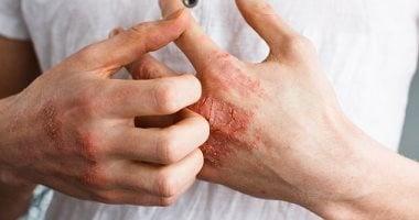سبب استمرار الإكزيما وجفاف الجلد في الشتاء