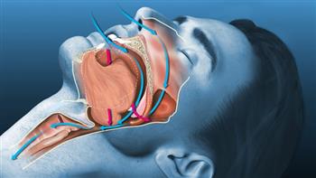 انتبه الجفاف وراء الاصابة بالشخير