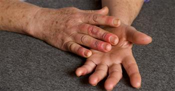 ️ماذا تعرف عن مرض رينود وعلاقته بالشتاء