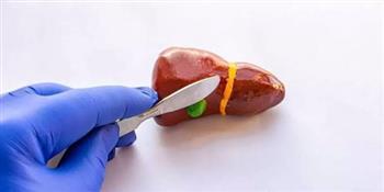 بعد استئصال المرارة.. طرق في الدايت اعتمدها