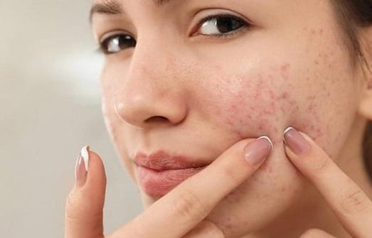 لبشرة صافية خلال الرضاعة.. علاجات منزلية تخلصك من حب الشباب