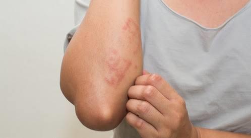 انتبه لأعراض الإصابة بحساسية الجلد