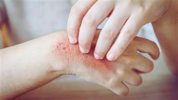 طرق الوقاية من العدوى الفطرية الجلدية
