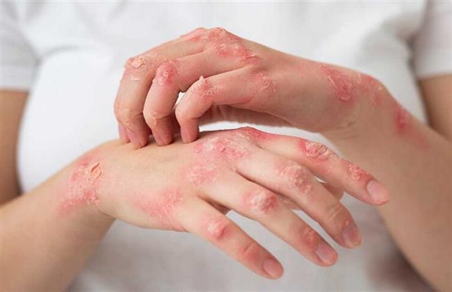 تعرف علي أنواع الإكزيما