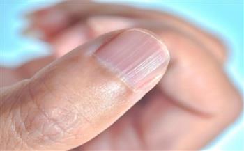 لون أظافرك علامة لهذه الأمراض