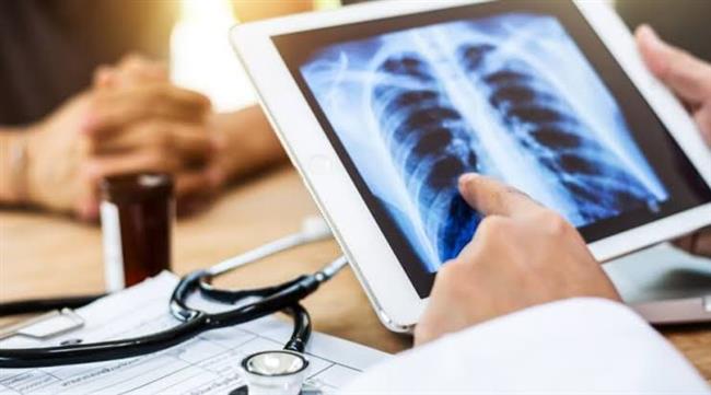 نصائح لمرضى الجلطة الرئوية بعد العلاج