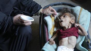 "الأونروا": 66 ألف طفل يعانون من سوء التغذية في قطاع غزة