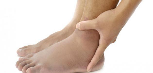 أعراض ارتفاع الأملاح في الجسم