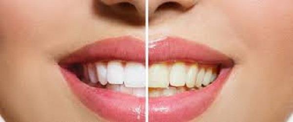بعيدًا عن المواد التجميلية.. وصفات طبيعية لتبييض أسنانك في المنزل