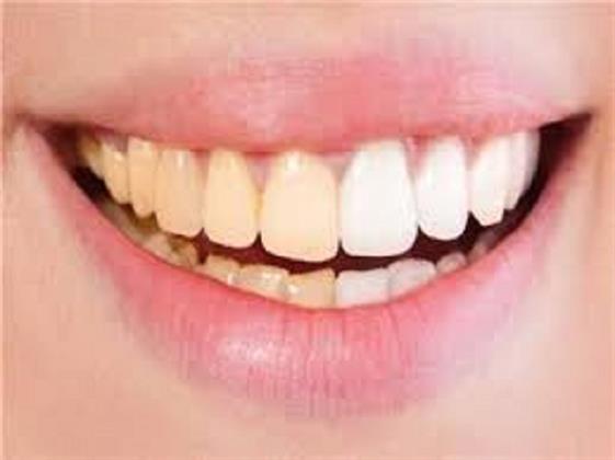 «الصحة» توضح 5 أسباب وراء اصفرار أسنانك