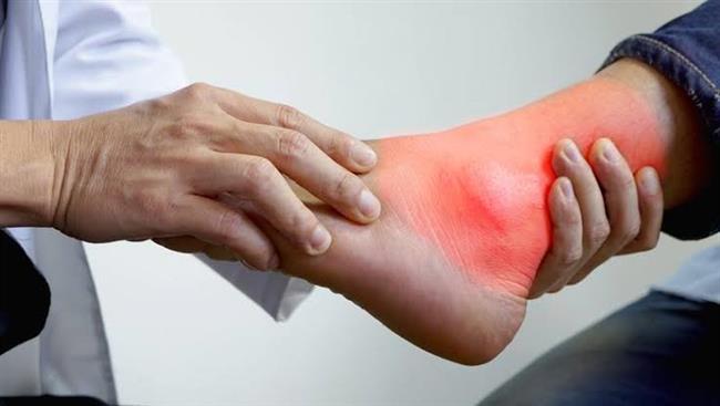 أعراض النقرس تصيب الكاحل ومفصل اليد