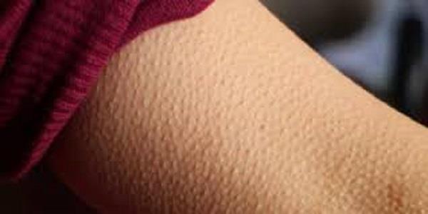 تعرفي على أسباب «جلد الوزة» وطرق طبيعية لعلاجه