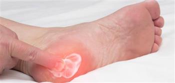 طرق علاج مسمار القدم