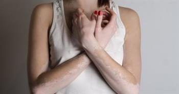 4 مضاعفات صحية لمرض البهاق