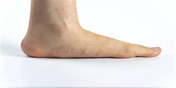أسباب وأعراض القدم المسطحة