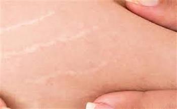 للتخلص من السيلوليت والخطوط البيضاء بالجسم.. أطعمة عليكِ تناولها