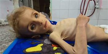 الجوع يفتك بأجساد الفلسطينيين في غزة.. الحصار الإسرائيلي يحوّل الطعام إلى حلم مميت   