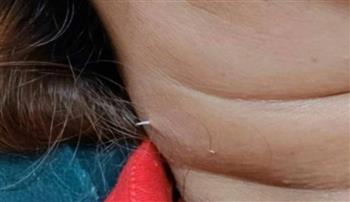 تايلاند.. سيدة أبتلعت عظمة سمكة أثناء الطعام فخرجت من رقبتها بعد أسبوعين