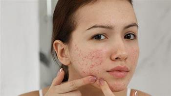 استعيدي جمال بشرتك.. تخلصي من الندبات بـ5 مكونات متوفرة في مطبخك