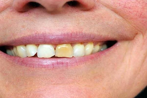 للتخلص من بقع الأسنان الصفراء.. اتبعي تلك الطرق الطبيعية 