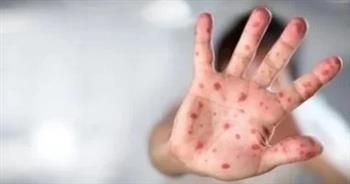 غانا تسجل أول حالة وفاة بفيروس جدري القردة