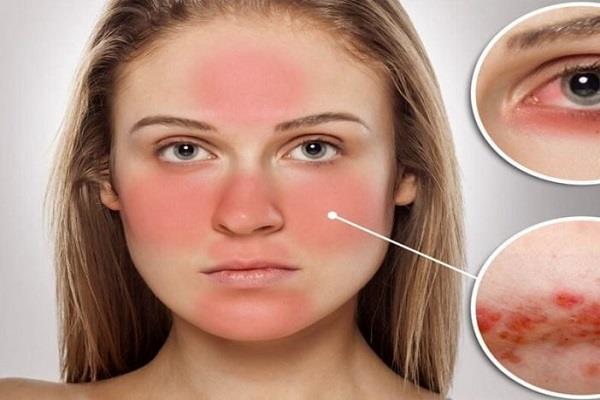 يظهر بعد سن الأربعين.. تعرف على مرض الذئبة الحمراء 