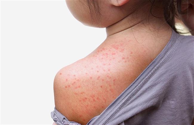 حمو النيل.. أعراضه وحلول الوقاية منه